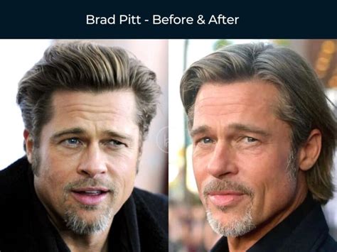 64 Celebrity Hair Transplants | Before & After Photos