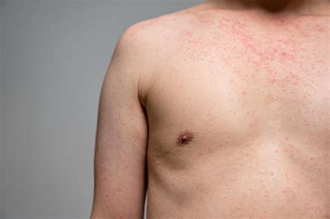 Premium Photo Dermatitis Rash Viral Disease With Immunodeficiency On