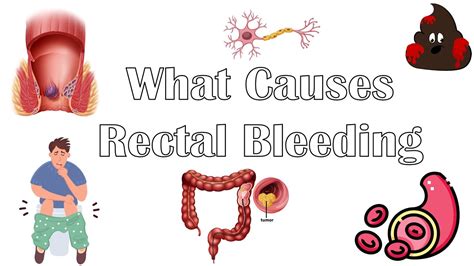 What Causes Per Rectal Bleeding Major Causes Of Blood In Stools