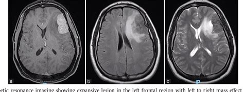 Figure 1 From Rosai Dorfman Disease Mimicking Images Of Meningiomas