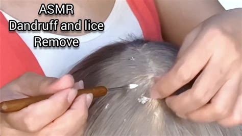 Asmr Super Tingly Scalp Check Dandruff And Lice Removal Scalp