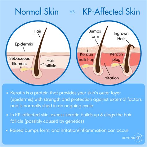 Treating Keratosis Pilaris The Beyondkp Guide