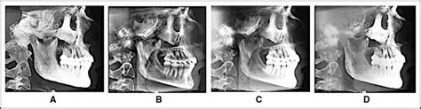 Automatic 3 Dimensional Cephalometric Landmarking Based On Active Shape Models In Related