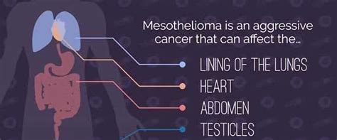 What You Need To Know About Mesothelioma