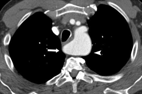 Subclavian Artery Anatomic Review And Imaging Evaluation Of Abnormalities Radiographics