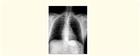 Upper Gastrointestinal Series Showing Type Ii Hiatal Hernia Download