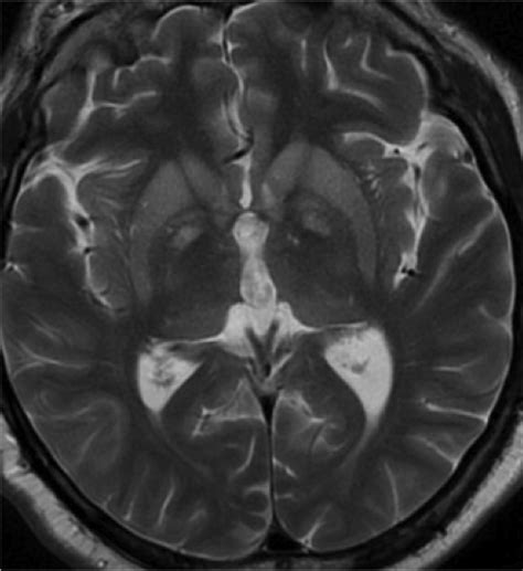 Sporadic Creutzfeldt Jakob Disease Scjd Image