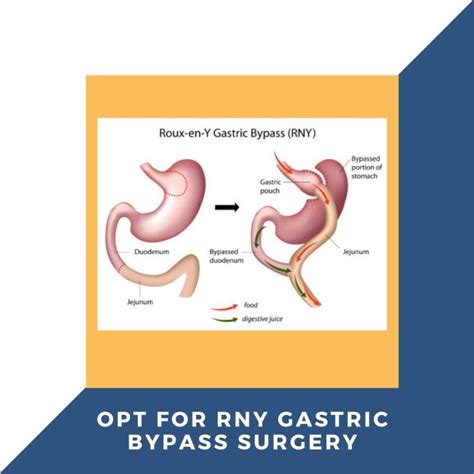 Why Opt for RNY Gastric Bypass Surgery in Perth? – Bariatric Surgery in Perth