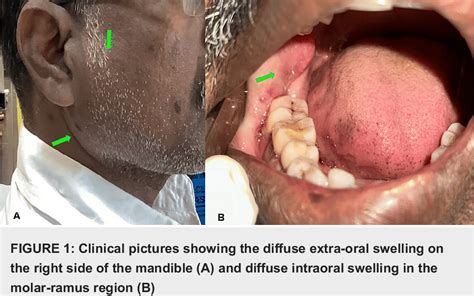 Figure From Odontogenic Keratocyst With Moderate Epithelial Dysplasia