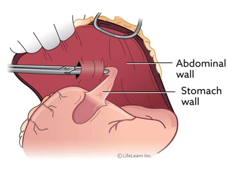 Gastric Dilatation And Volvulus (GDV): What Causes It?