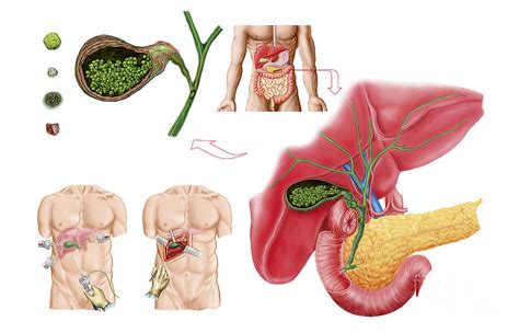 Illustration Depicting Cholecystectomy Digital Art by Stocktrek Images ...