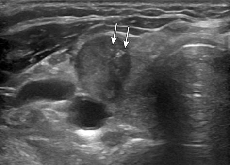 Entendo a tireoide aspectos clinicos e ultrassonográficos