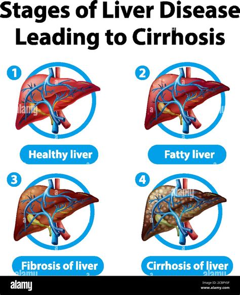 Etapas De La Enfermedad Hep Tica Que Conducen A La Ilustraci N De La