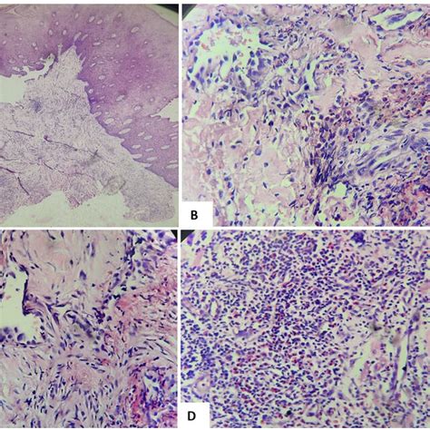 A Scanner View 40x Hyperplastic Squamous Epithelium With Underlying