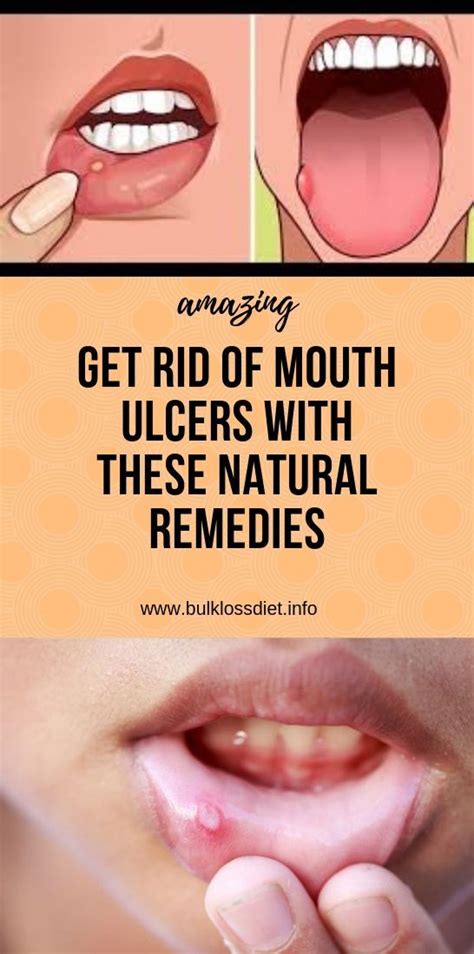 Get Rid Of Mouth Ulcers With These Natural Remedies In 2020 Health And Wellness Coach Natural