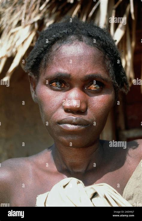 Onchocerciasis View Of A Young Mother Blinded By Onchocerciasis River