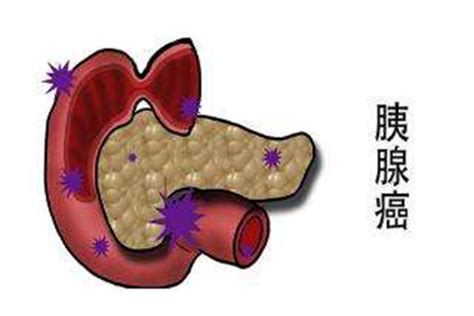 胰腺癌的异常表现有哪些？ 笑医笑在线 医院信息分享和健康知识咨询服务平台。