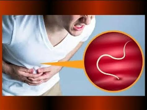 Las Causas De La Parasitosis Intestinal Youtube