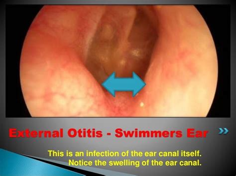 Otoscope And Its Uses