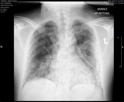 Plain Anterior Posterior Chest Radiography Demonstrating Radiolucent