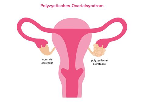 PCO Syndrom Ursachen Symptome Und Behandlung