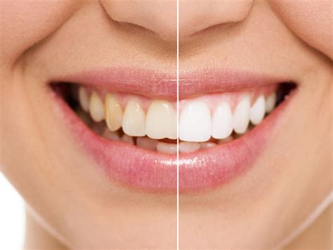 Teeth Whitening Benowa Gold Coast Dental Teeth Whitening