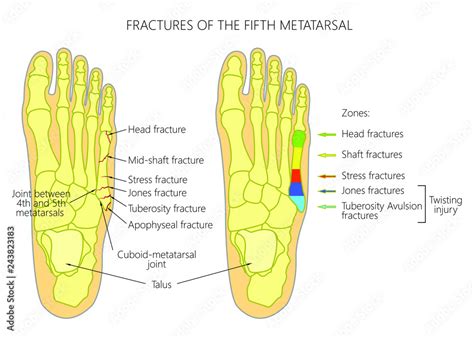 Illustration Diagram Of The 5th Metatarsal Fractures Types And Zones