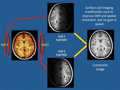 Parallel Imaging Pi Questions And Answers In Mri