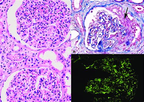 A Diffuse Endocapillary Proliferation On Light Microscopy