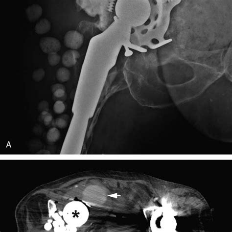 Anteroposterior Radiograph Of The Pelvis Shows A Custom Made Hip