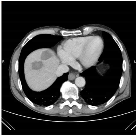 Medicina Free Full Text Percutaneous Navigation Under Local