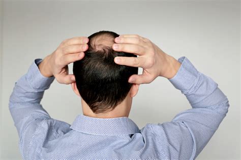 A Guide To Hair Loss Disorders Diagnosis Treatment And More Angeline