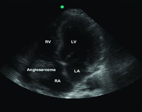 Incidental Identification Of Right Atrial Mass Using Bedside Ultrasound