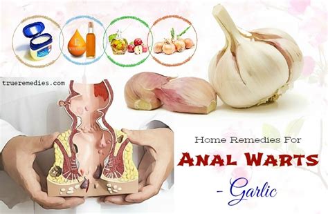 Top 22 Natural And Effective Home Remedies For Anal Warts