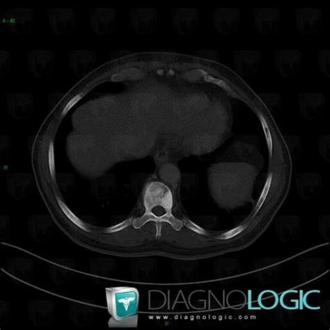 Cas Radiologie M Tastase Scanner Diagnologic