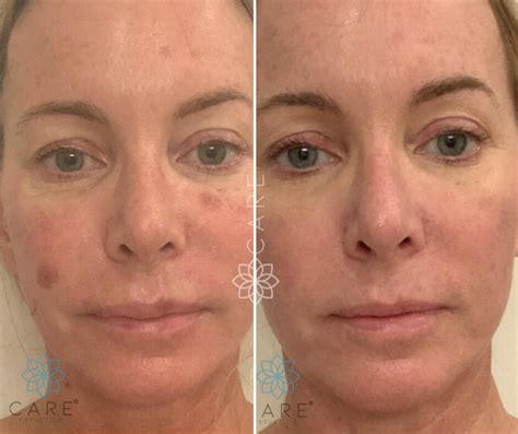 Before And After Skin Treatments In Jupiter Fl Care Esthetics