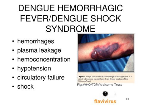 Dengue Shock Syndrome