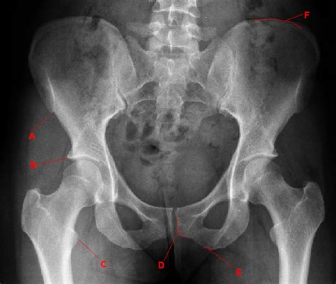 Sites Of Tendon Insertion On A Pelvic Radiograph The Bmj