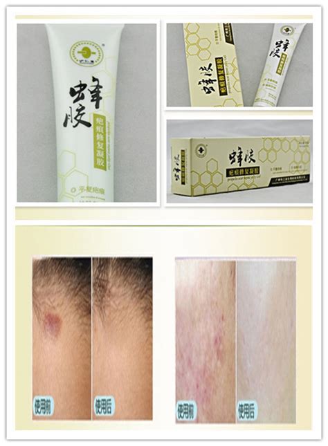 Hot Sale Top Chinese propolis scar repair gel remove scar cream for surgical scars burn scar ...