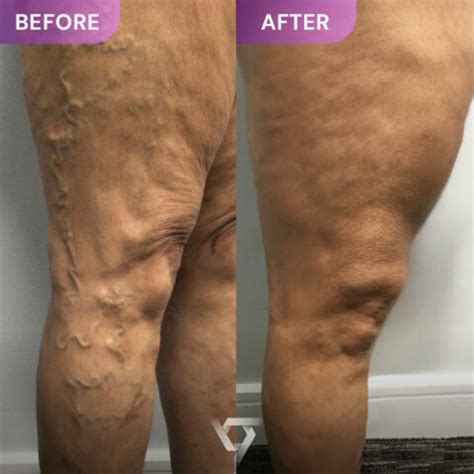 Ivy League Trained Vein Doctors Varicose And Spider Veins Before And