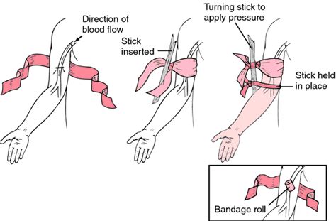 Tourniquet test | definition of tourniquet test by Medical dictionary