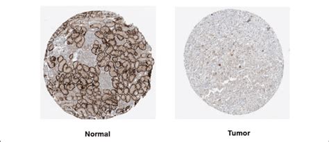 Mitd Protein Expression Levels In Normal And Kirc Tissues The