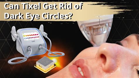 Treating Dark Eye Circles With Tixel Radium Medical Aesthetics Youtube