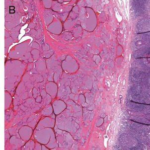 Ectopic Thyroid Gland Shown By Computed Tomography Scan A Iodine