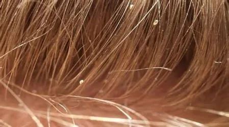 How To Identify Lice Nits Lice Eggs