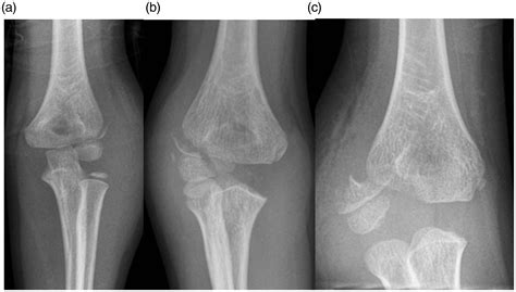 Lateral Condyle Fx Humerus Closed