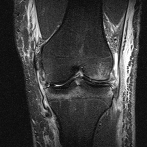 Stener Like Lesion Of The Superficial Medial Collateral Ligament