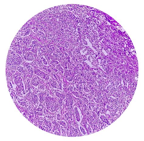 Transitional Cell Carcinoma