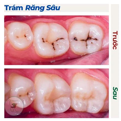 Tổng hợp hình ảnh trám răng sâu trước và sau khi điều trị