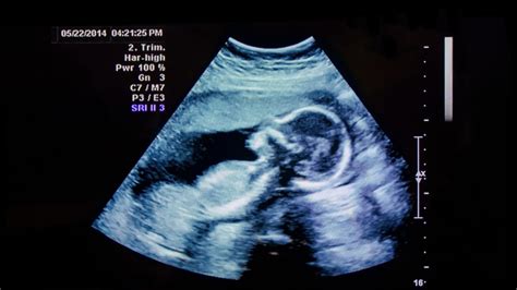 How To Read An Ultrasound Ultrasound Solutions Corp